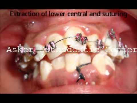 Separatory ortodontyczne