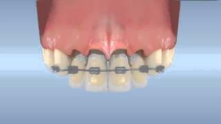 Dental Implant application