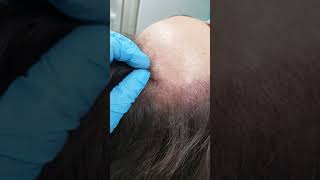 Female Scalp Receeding Hairline Densification Micropigmentation SMP by El Truchan @ Scalp Micro Defi