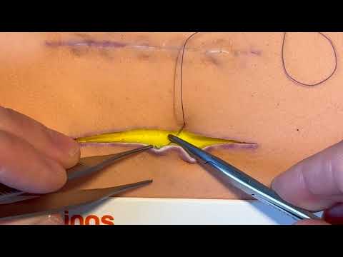 THE most important suture technique you must master! - The buried dermal suture