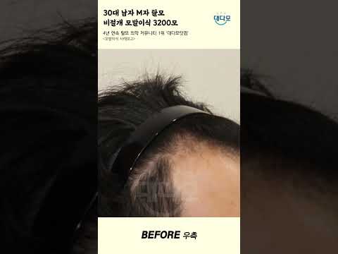 30多岁男子M型脱发,非切开式毛发移植 3200发, 一年的变化 Before & After [#shorts]