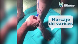 Operación de varices con Endoláser