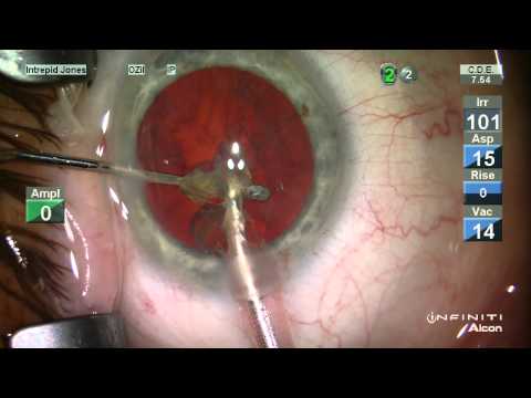 Phaco with Unanticipated Advanced Diffuse Zonulopathy