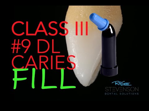 Class III Composite Restoration #9 