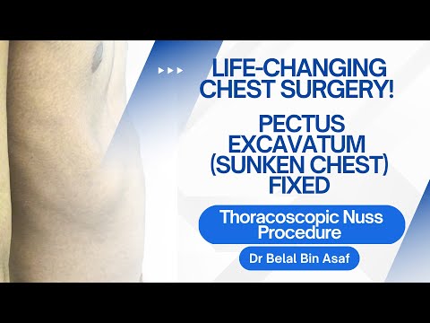 Pectus Excavatum Fixed! | Thoracoscopic Nuss Procedure Success Story - Dr Belal Bin Asaf- Medanta