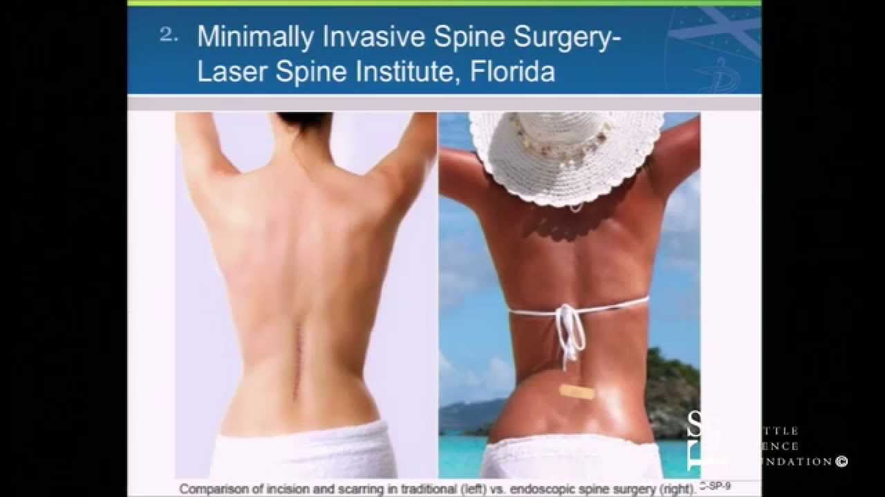 MIS TLIF - Expandable Cage Technology by Khalid M. Abbed, M.D.