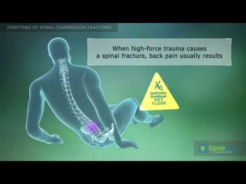 Spinal Compression Fracture Symptoms