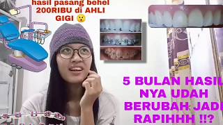 Pasang behel di ahli gigi 200ribu PERCUMA