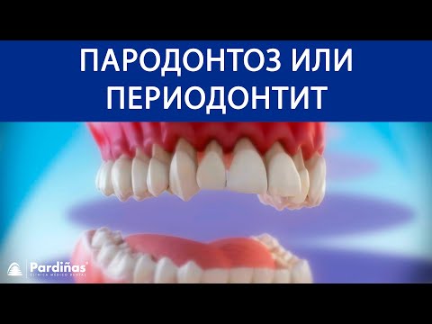 Пародонтоз или периодонтит ©