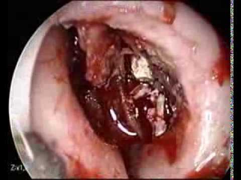 Treatment for intraductal papilloma