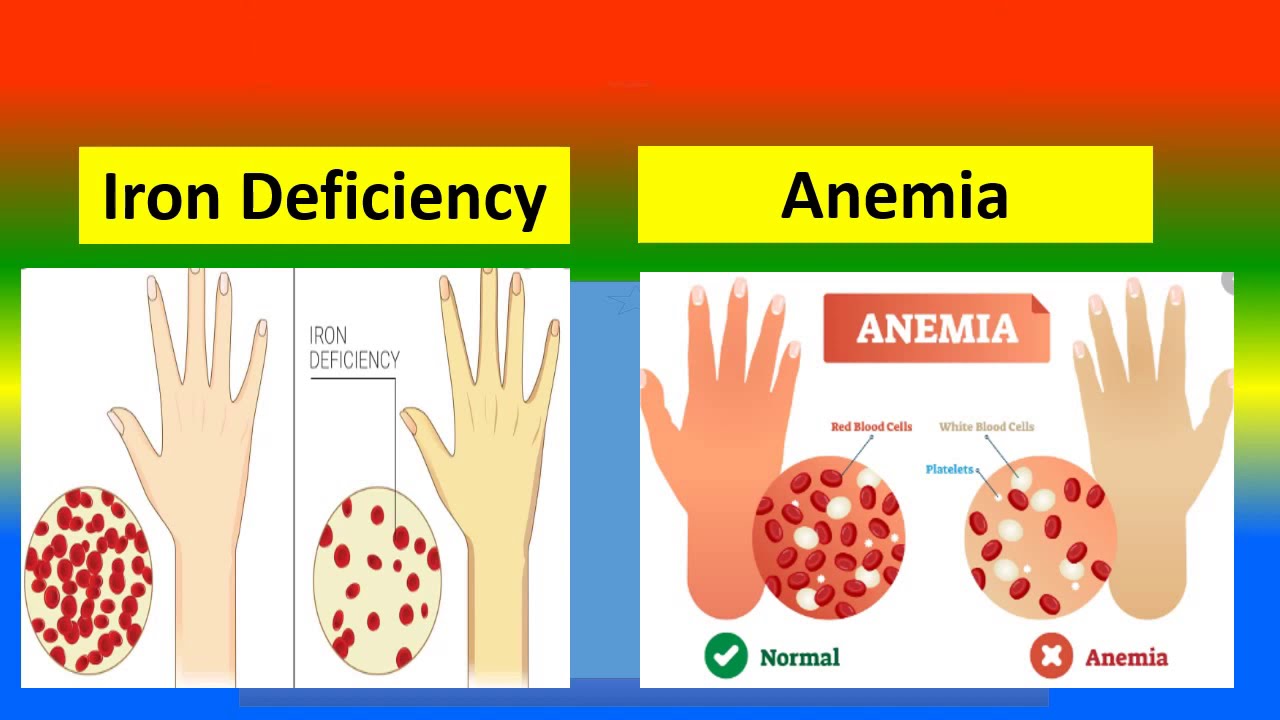 What is the difference between iron deficiency and anemia? Zandex
