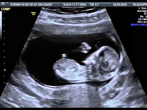 Ecografia: feto a 12  settimane