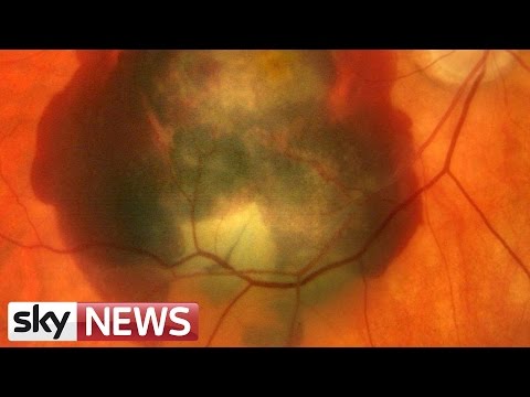 Ground-Breaking Operation To Cure Form Of Blindness