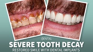 Dental Implants Restore Severely Decayed Smile
