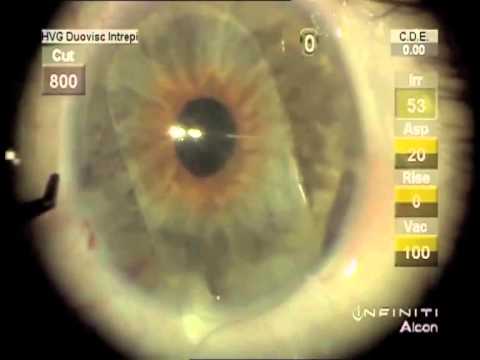 Manejo de lente intraocular subluxado - complejo de bolsa con LIO-CA