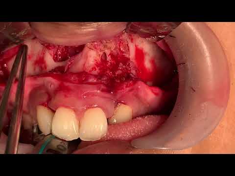 Anterior Maxillary Distraction