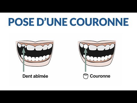 download lagu mp3 mp4 Couronne Dentaire Cramique, download lagu Couronne Dentaire Cramique gratis, unduh video klip Couronne Dentaire Cramique