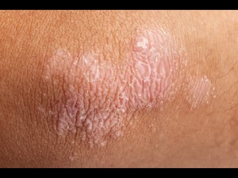 Usuwanie przebarwień skóry - Aestetic Clinic