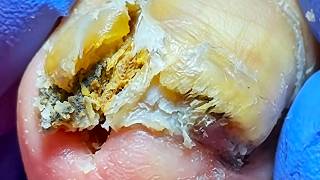 Amazing Ingrown Toenail Video - Is There A Stone Hidden In Your Toenail【Xue Yidao】