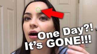 How I got rid of a PIMPLE in ONE DAY! (WARNING: kind of gross)