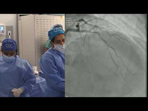 PCI of FFR Guided Multiple LAD/Diagonal Lesions - Sun Pharma April 2022