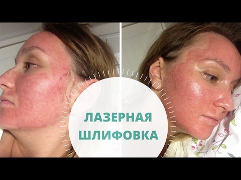 Крем рба отбеливающий Вещества отбеливающие кожу