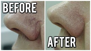 💝  TREATING SPIDER VEINS ON NOSE  💝