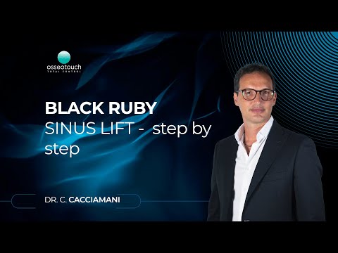 Crestal sinus lift step-by-step procedure with Black Ruby DLC osteotomes