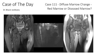 Case of the Day - 111 - 2025 09 30 - Diffuse Marrow Change - Red Marrow or Diseased Marrow?