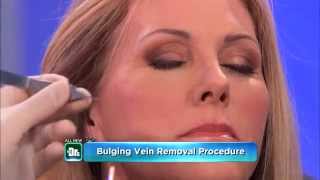 Removing Varicose Veins Under Eyes -- The Doctors