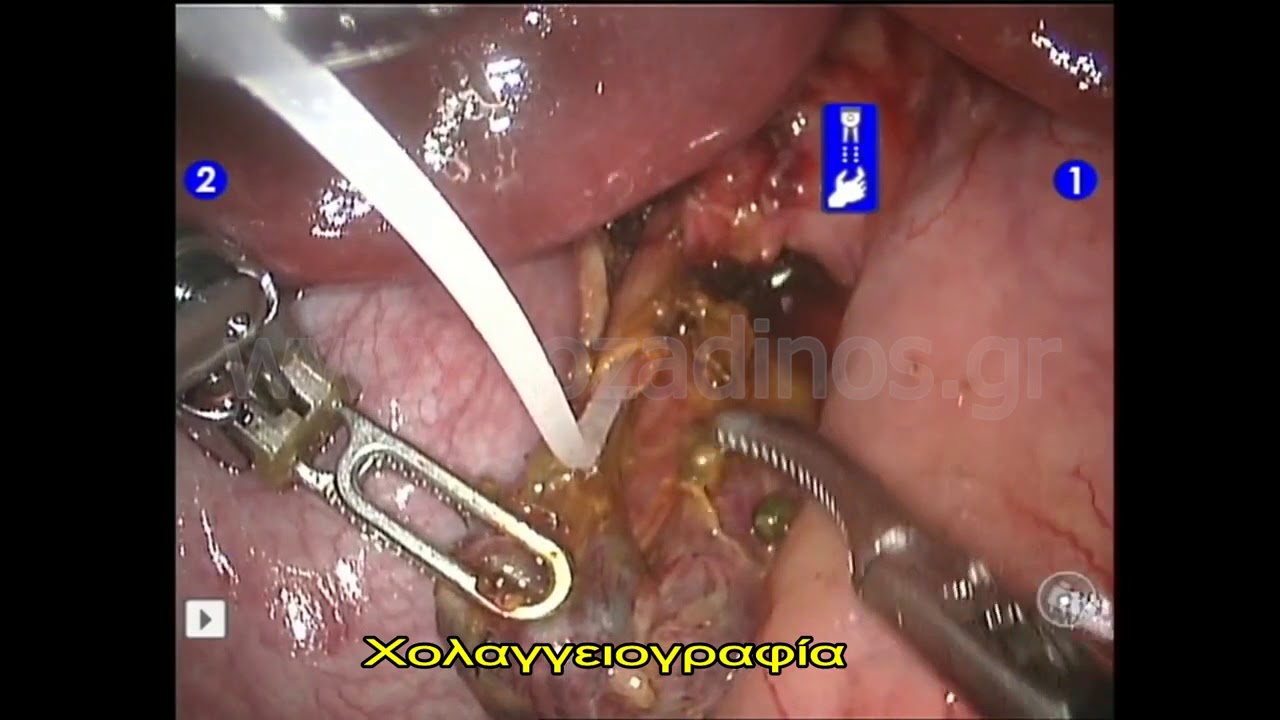 ΡΟΜΠΟΤΙΚΗ ΧΟΛΟΚΥΣΤΕΚΤΟΜΗ ΔΙΕΓΧΕΙΡΗΤΙΚΗ ΔΙΕΡΕΥΝΗΣΗ ΧΟΛΗΔΟΧΟΥ ΠΟΡΟΥ F