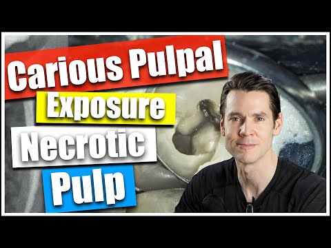 Carious Pulpal Exposure and Necrotic Pulp