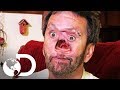 El Hombre Con Un Hueco En El Rostro | Mi Cuerpo, Mi Desafío L Discovery Latinoamérica