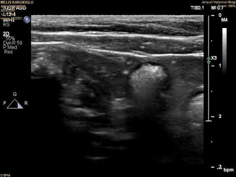 Intestinal Foreign Body in a cat ultrasound