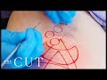 Radical Beauty: Cutting Skin-Deep With a Scar Artist