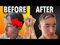 My Brother Cured his Vitiligo as a vegan teen