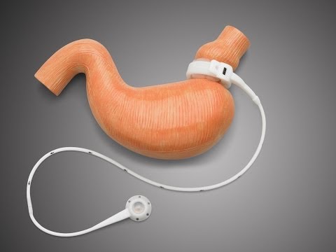 Gastric Band in Ireland. Auralia Weight Loss Clinic www.healthyweight.ie