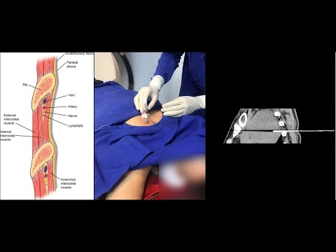 Borda superior da costela inferior