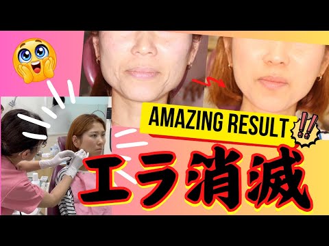 コンプレックスだった顎のエラを手術なしでなくす方法とは？