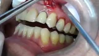 Popping a Dental Abscess