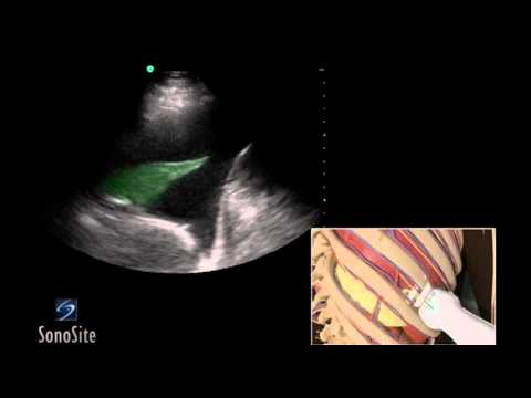 How To: Ultrasound Guided Thoracentesis Exam 3D Video