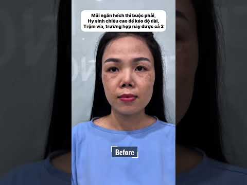 Revision Structural Rhinoplasty (2nd Procedure)