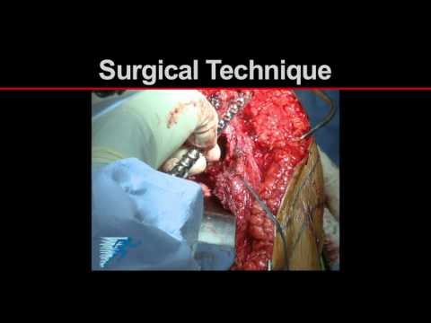 Shoulder Arthrodesis | Shoulder Stabilization Procedure