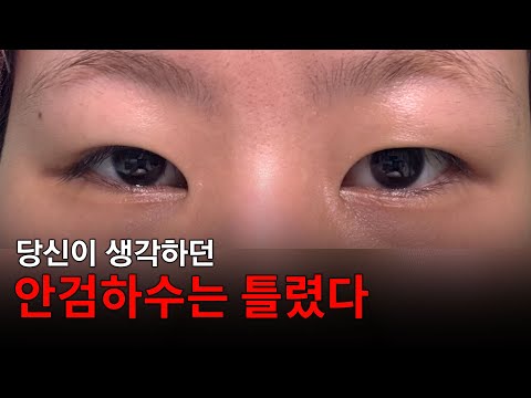 上睑下垂 01