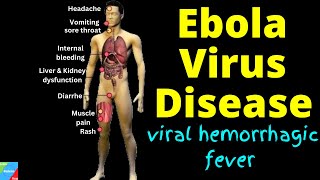 Ebola Virus Disease: Causes, Symptoms, Diagnosis, Treatment & Prevention