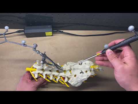 Navigated Pars fracture repair using Brainlab navigation