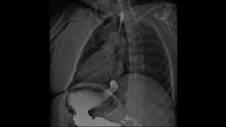 Dynamic Digital Radiology View of Esophagus: Esophagogastroduodenoscopy (SEGD Test) part 6