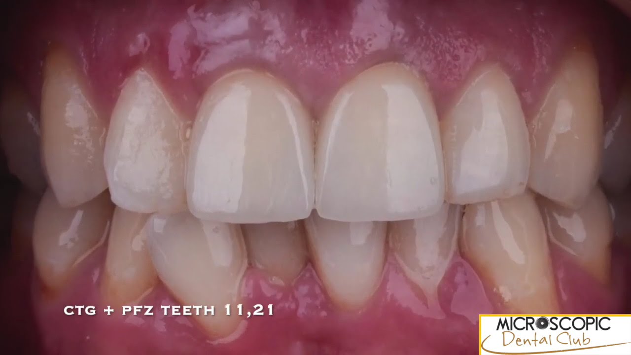 SOFT TISSUE AUGMENTATION IN ESTHETIC ZONE & ZIRCONIA CROWNS BY DR. ARIEL SAVION