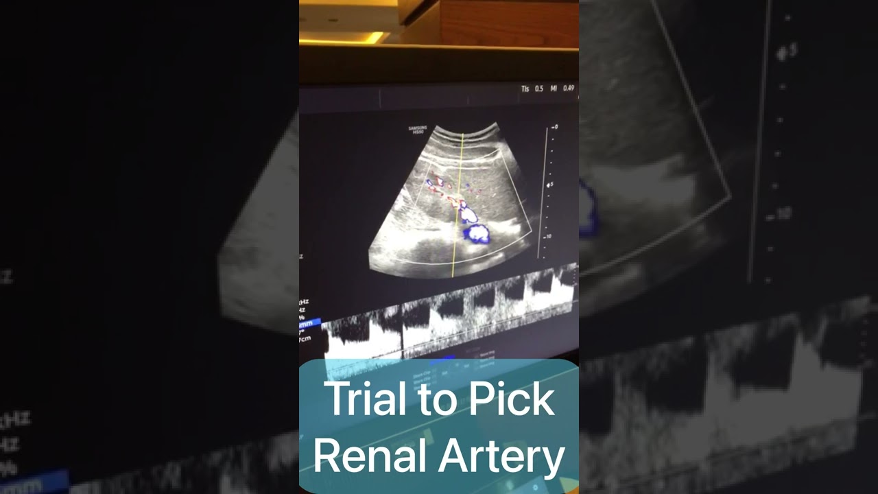 Trial to Pick Renal Artery by Doppler - Arabic Version
