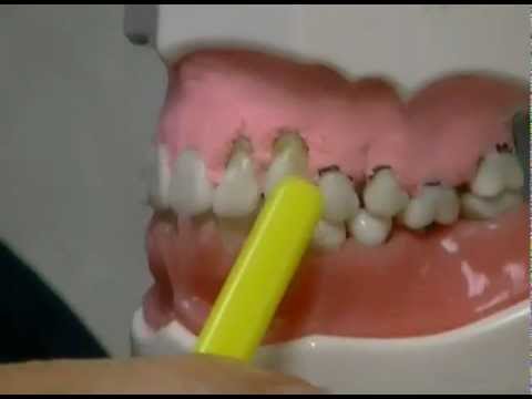 What Causes Gum Recession and How To Treat It